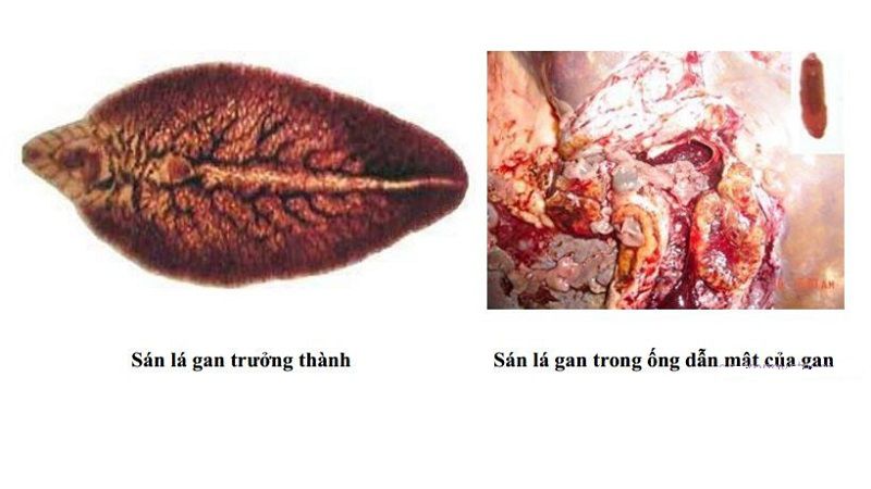 Bệnh sán lá gan