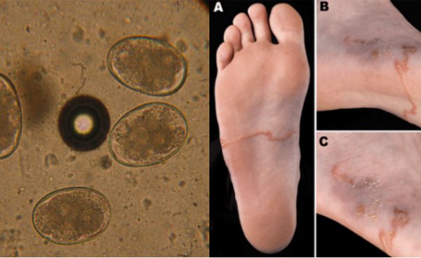 Giun lươn Strongyloides