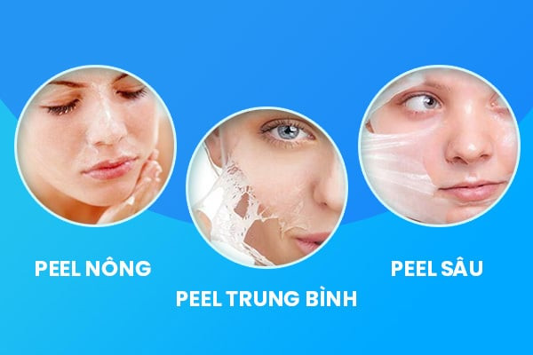 các cấp độ peel da