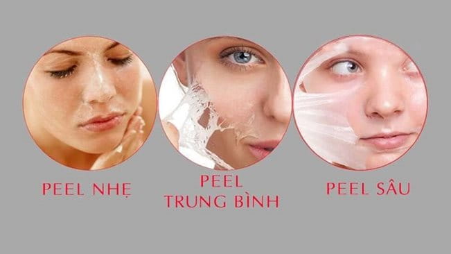 Nên Lựa Chọn Cấp Độ Peel Da Nào Phù Hợp Với Bạn ? 