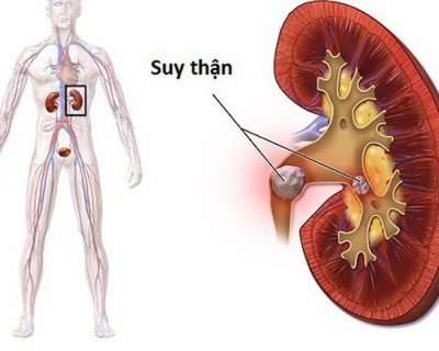 8 BIỂU HIỆN DA QUAN TRỌNG CẦN BIẾT Ở BỆNH NHÂN MẮC BỆNH LÝ THẬN 