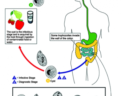 BỆNH BALANTIDOSIS