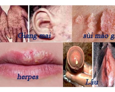 BỆNH LÂY TRUYỀN QUA ĐƯỜNG TÌNH DỤC (STDs)