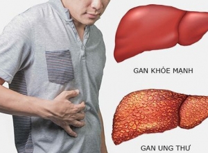 Mắc ung thư do tự bỏ điều trị viêm gan B