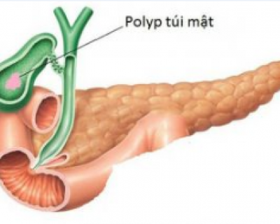 Polyp túi mật - Hiểu đúng bệnh, chữa đúng cách