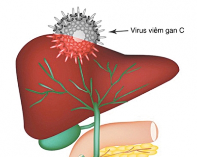 Chuẩn Đoán Bệnh Viêm Gan Virus C