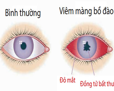 Viêm Màng Bồ Đào Mắt Nguy Hiểm Ra Sao?