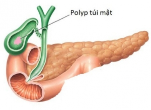 Túi mật và những vấn đề cần lưu ý